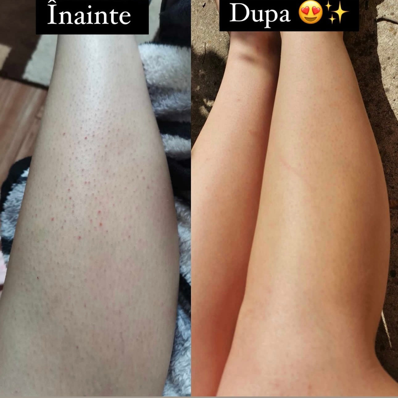 Pachet Epilare Perfecta