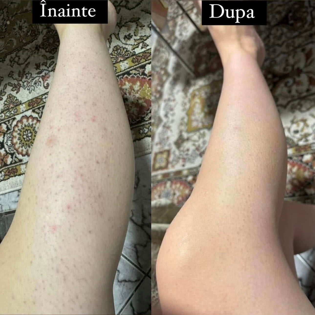 Pachet Epilare Perfecta